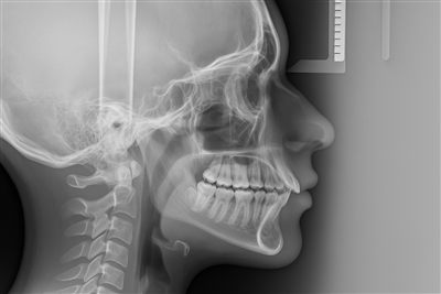 Cephalometric X-Ray